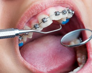 https://dentist-albania.com/wp-content/uploads/2021/10/what-is-included-in-orthodontic-treatment-320x256.jpg